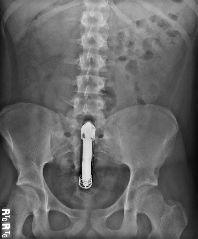 big gay ass sex original butt dildo doctor lol uploaded vibrating xray livetweet